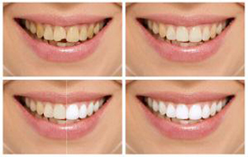 Smile Makeover provided by Raj Talwar DDS in Lafayette, CA