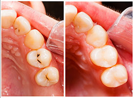 Composite Fillings provided by Raj Talwar DDS in Lafayette, CA