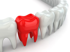 Single Tooth Implants provided by Raj Talwar DDS in Lafayette, CA