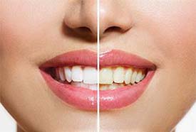 Teeth Whitening provided by Raj Talwar DDS in Lafayette, CA