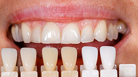 Porcelain Veneers provided by Raj Talwar DDS in Lafayette, CA